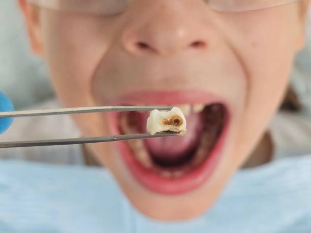 Best Emergency Wisdom Tooth Extraction in Broadview Park, FL